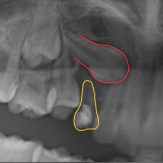 子どもの歯レントゲン