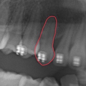 矯正治療が進んだ後のレントゲン