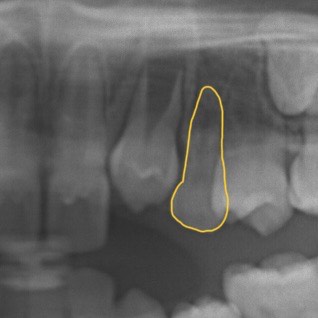 子どもの歯のレントゲン