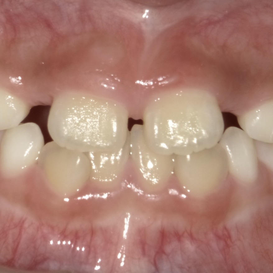 正中離解症例画像