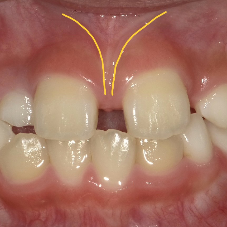 正中離解症例画像
