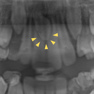 正中離解症例レントゲン