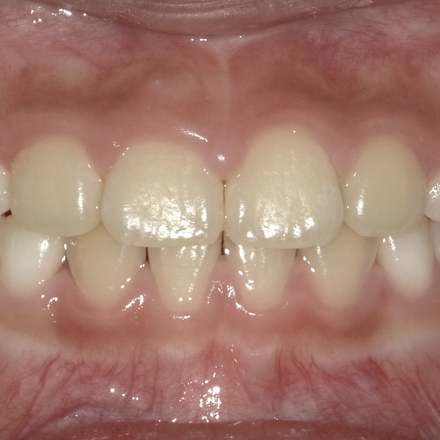 正中離解治療後症例画像