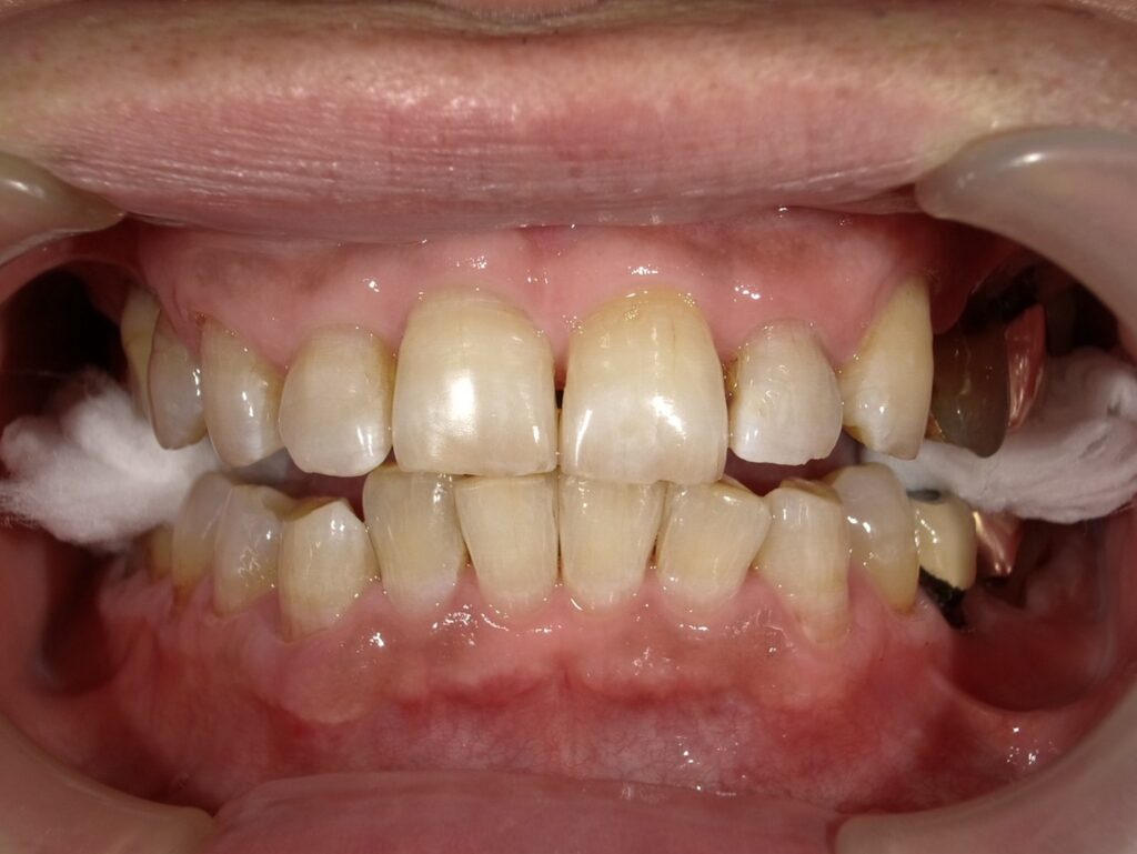 ホワイトニング1回目