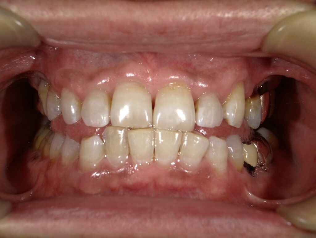 ホワイトニング3回目