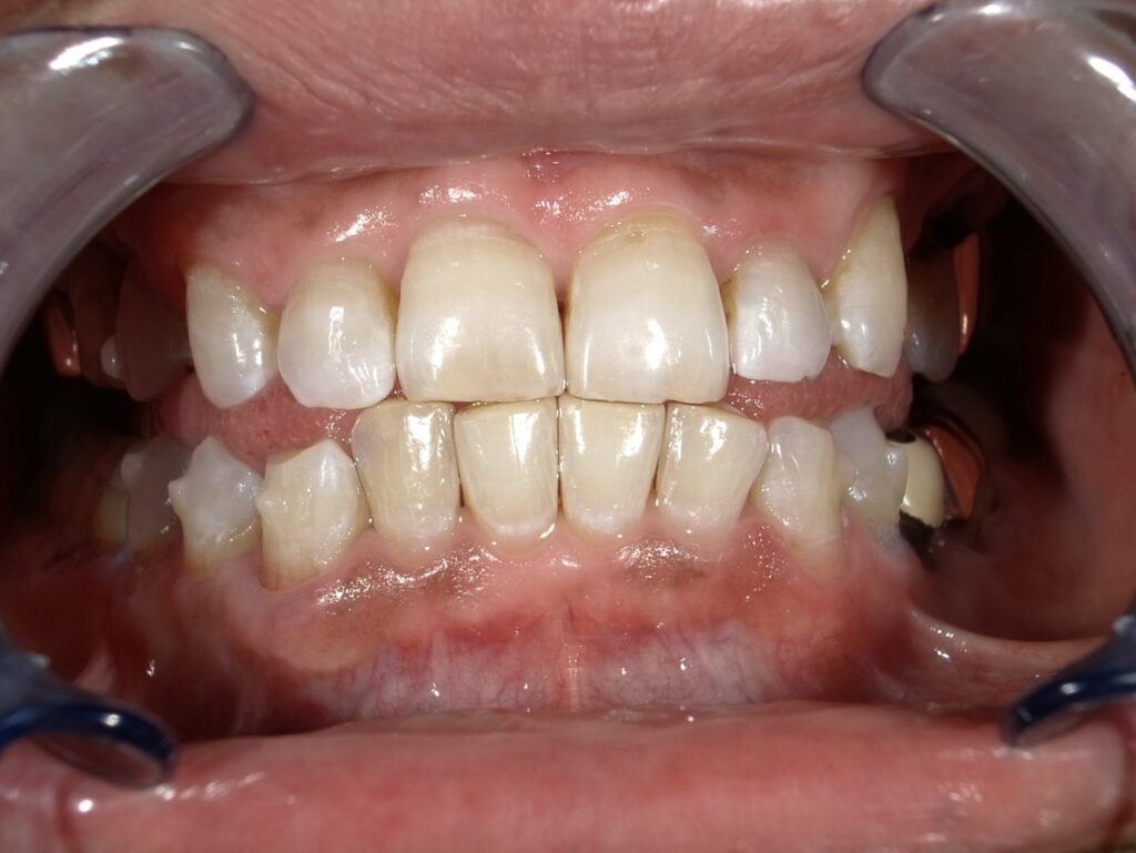 ホワイトニング5回目