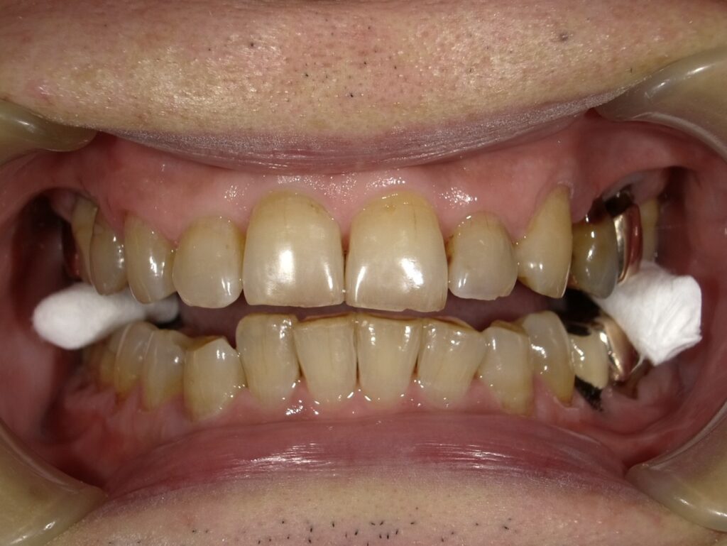 オフィスホワイトニング初診時