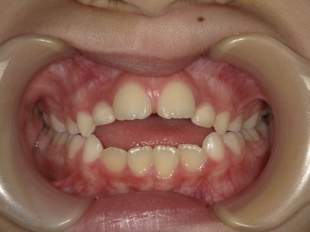 子どもの開咬の症例画像