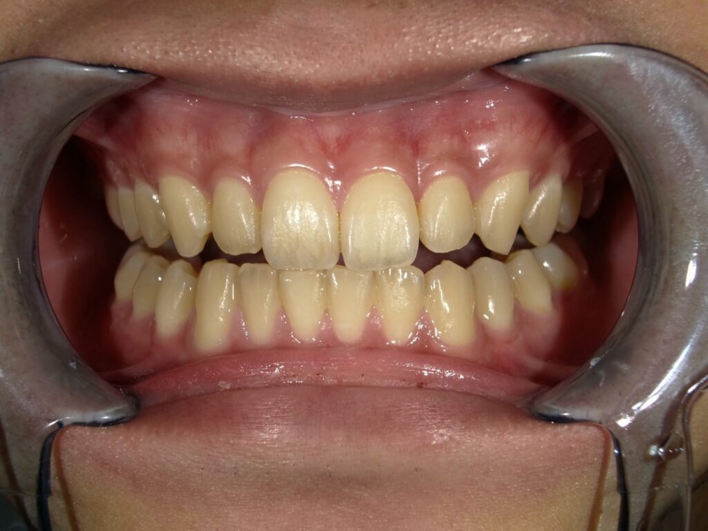 オフィスホワイトニング初診時