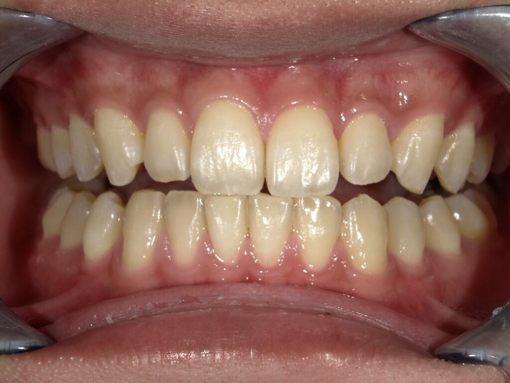 オフィスホワイトニング1回目