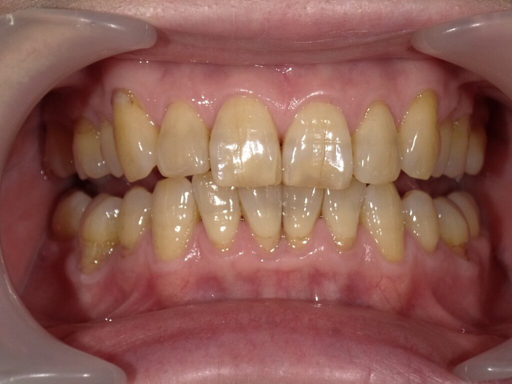 オフィスホワイトニング初診時