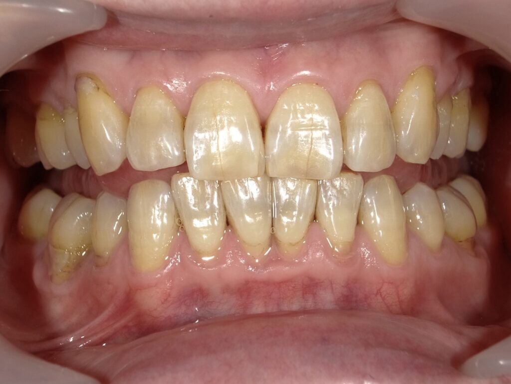 オフィスホワイトニング1回目