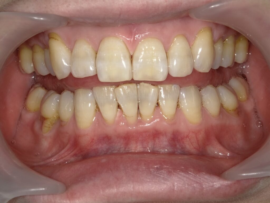 オフィスホワイトニング5回目