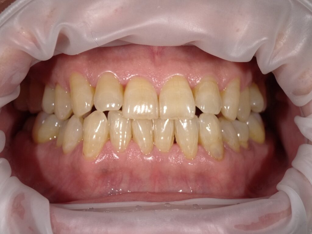 オフィスホワイトニング初診時