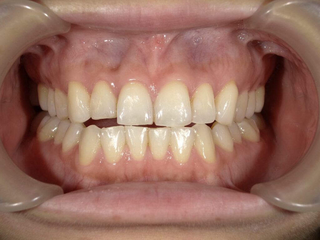 オフィスホワイトニング初診時