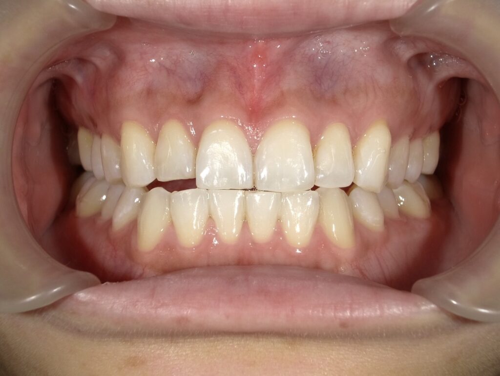 オフィスホワイトニング1回目