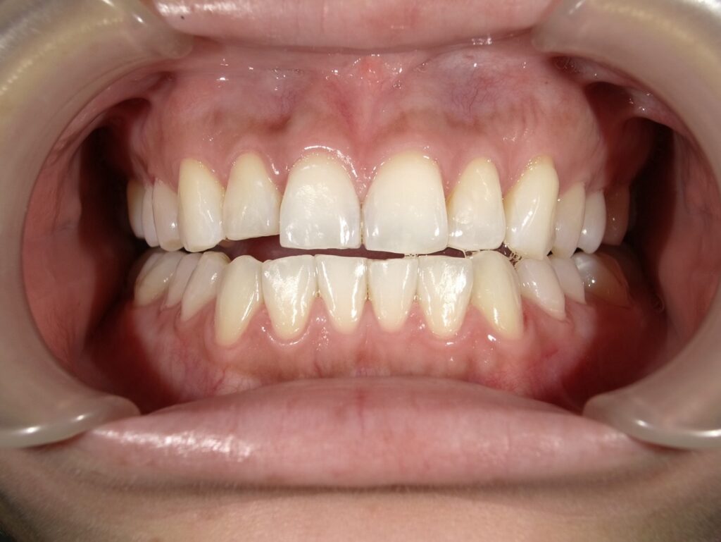 オフィスホワイトニング5回目