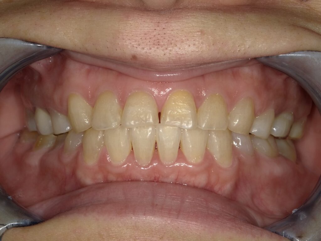 オフィスホワイトニング初診時