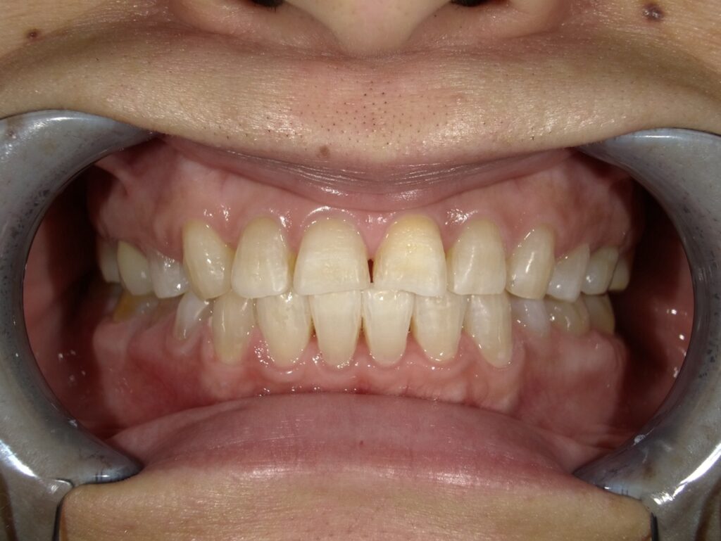 オフィスホワイトニング1回目