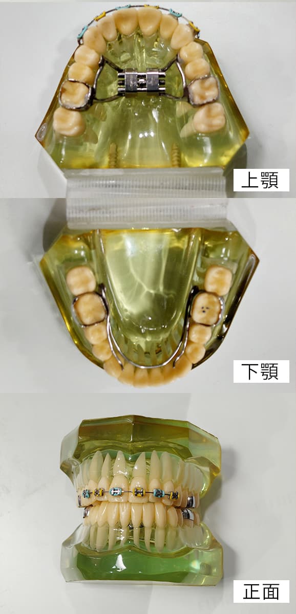 上顎拡大装置の模型
