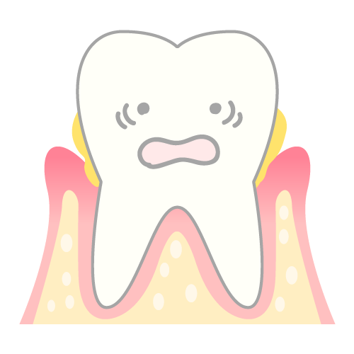 歯周病のイラスト