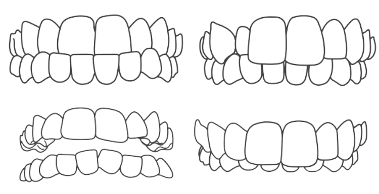 悪い歯並びのイラスト