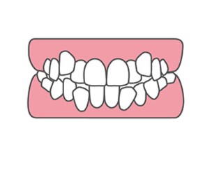 叢生イラスト