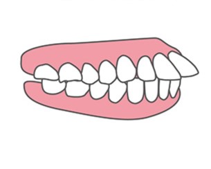 軽度の出っ歯イラスト