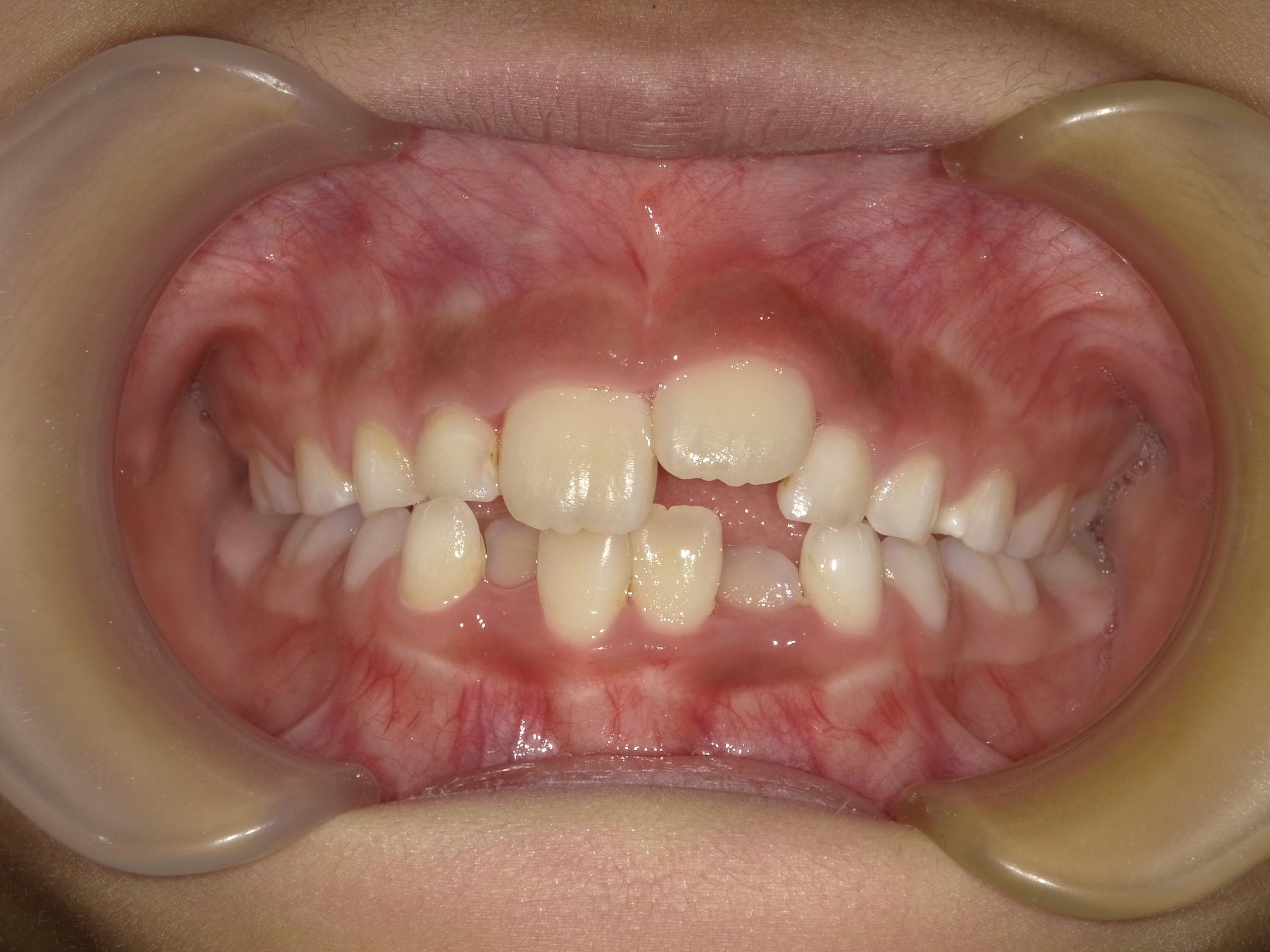 小児矯正(I期治療)Before
