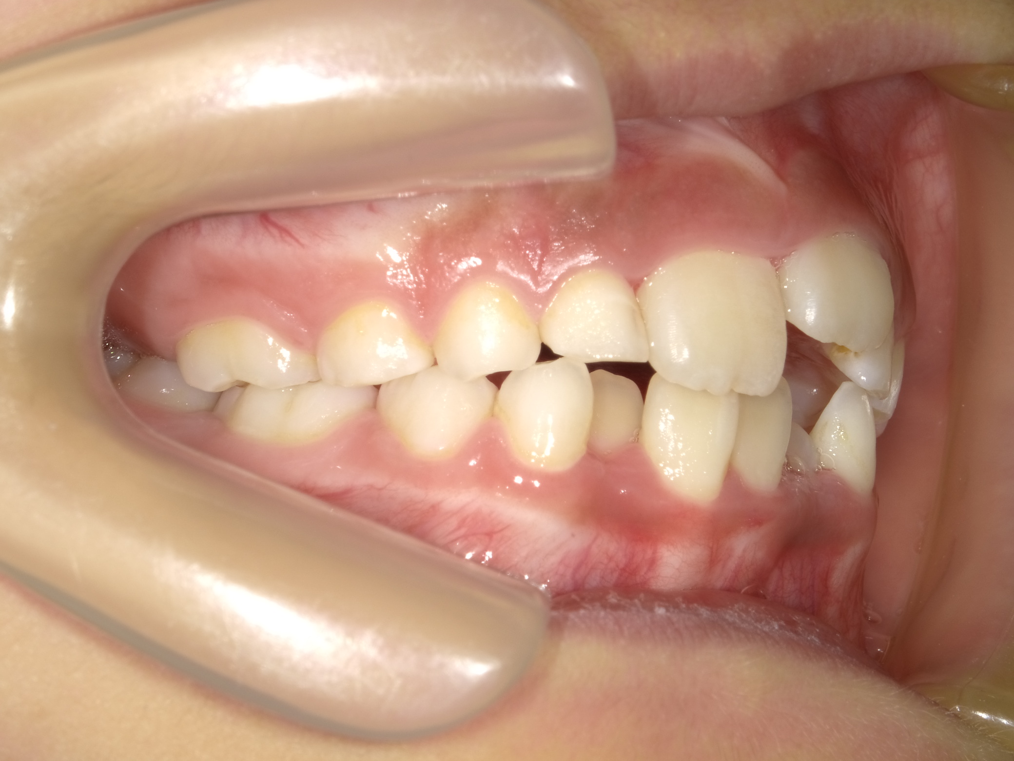 小児矯正(I期治療)Before