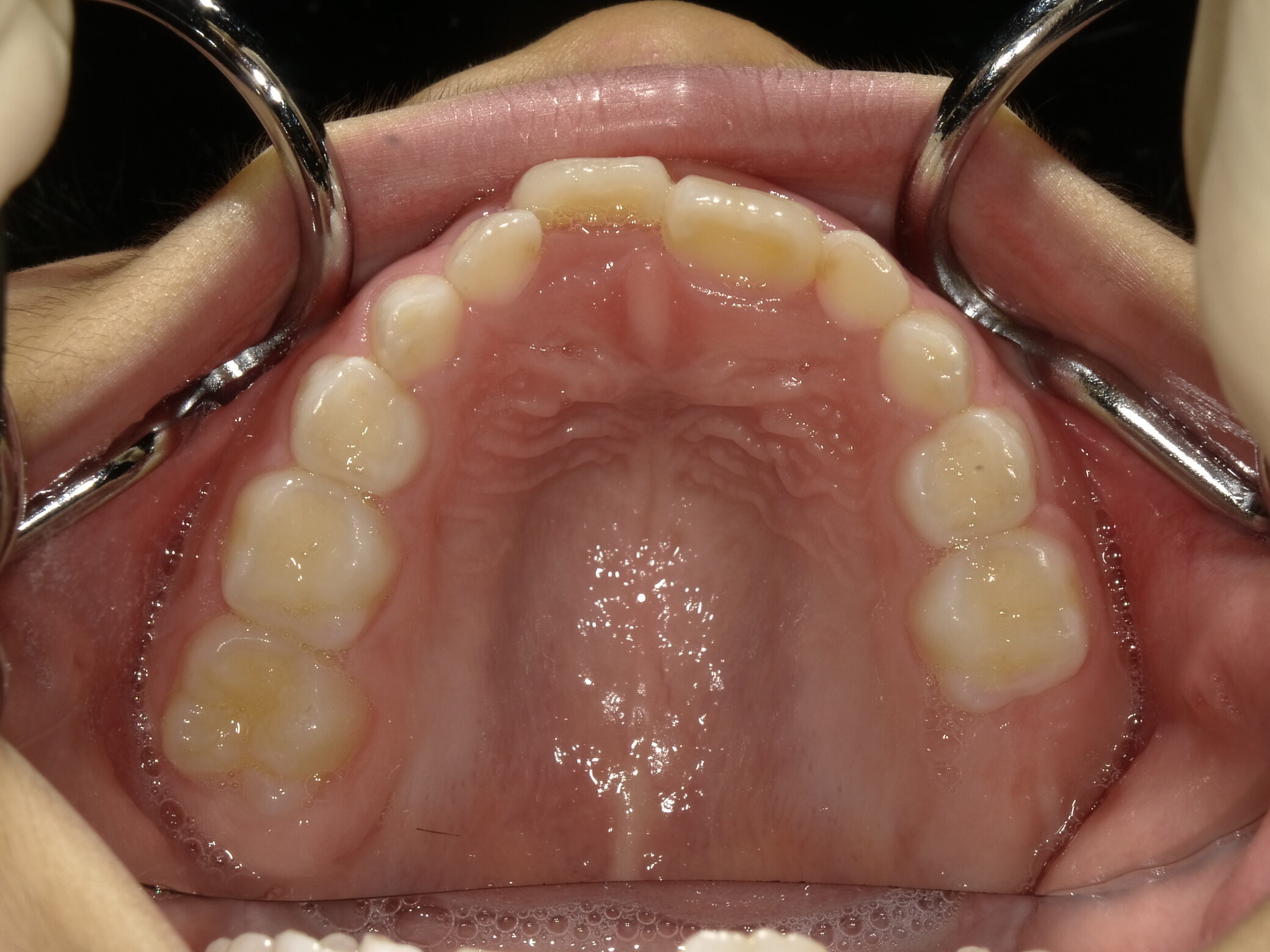 小児矯正(I期治療)Before