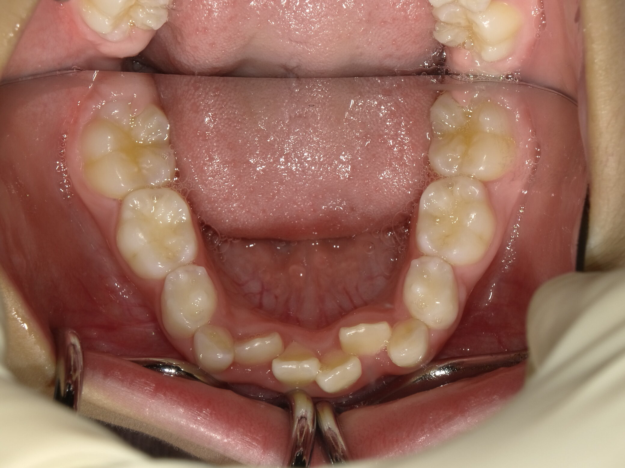 小児矯正(I期治療)Before
