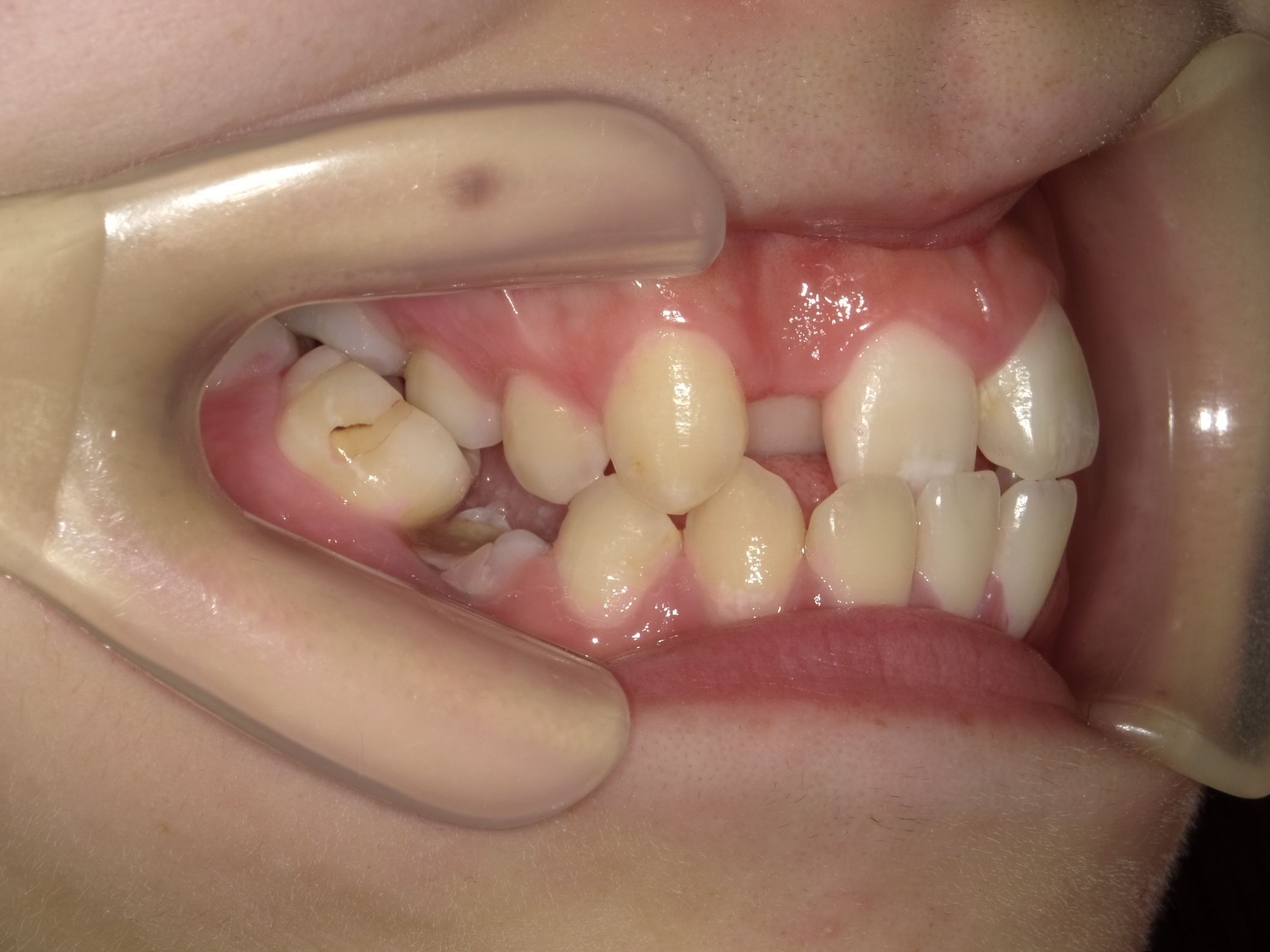 成人矯正(II期治療)Before