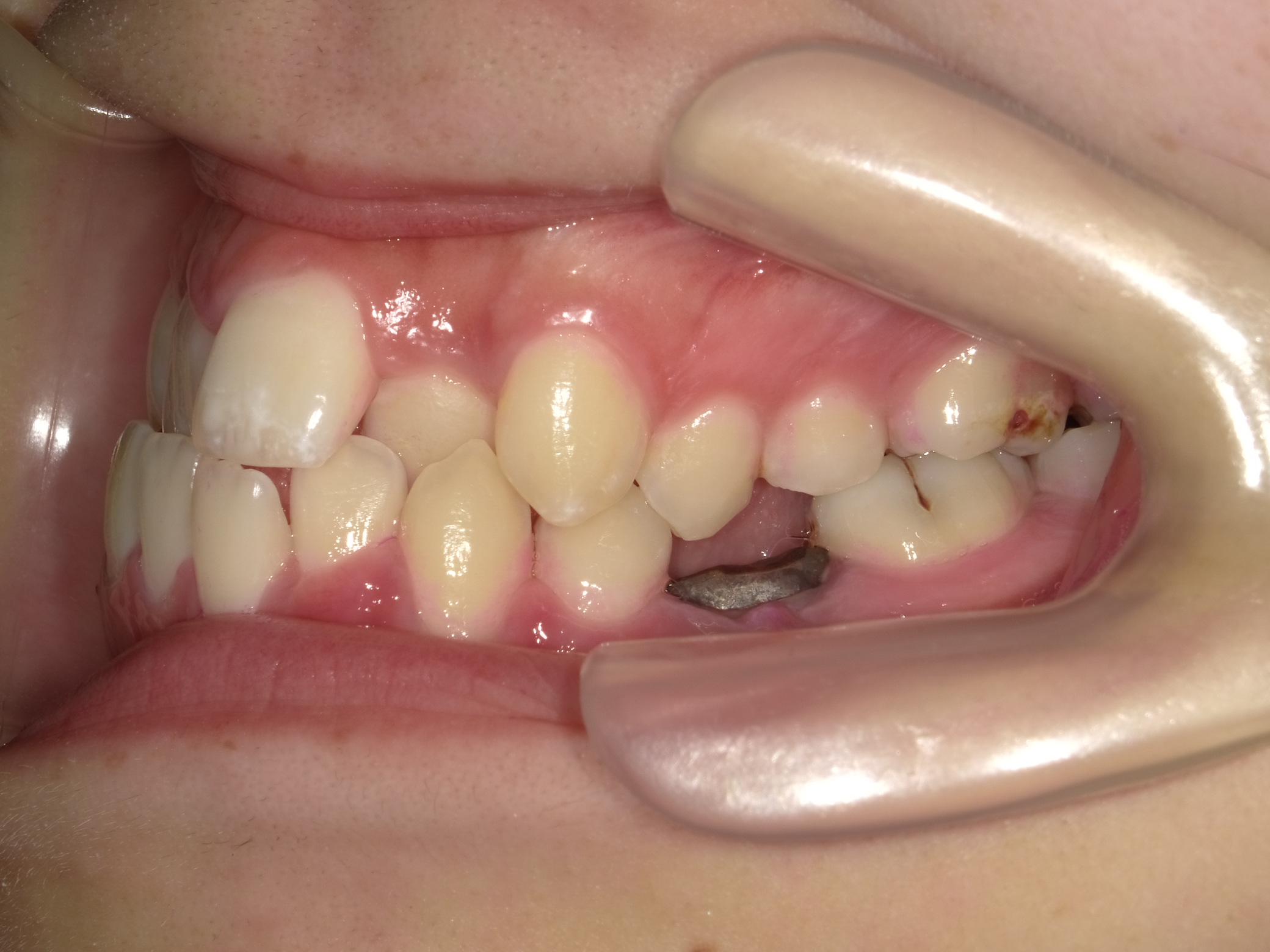 成人矯正(II期治療)Before