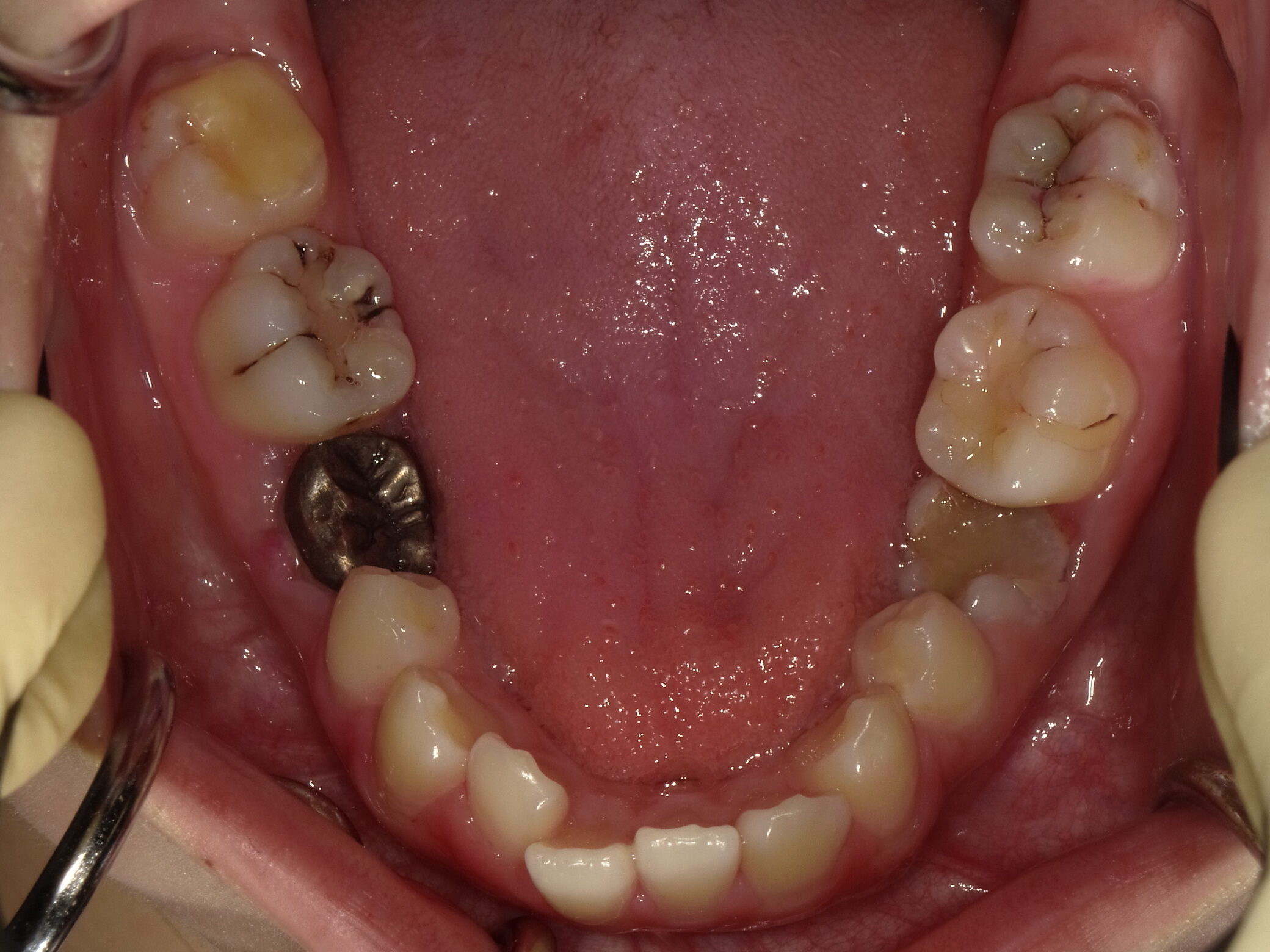 成人矯正(II期治療)Before