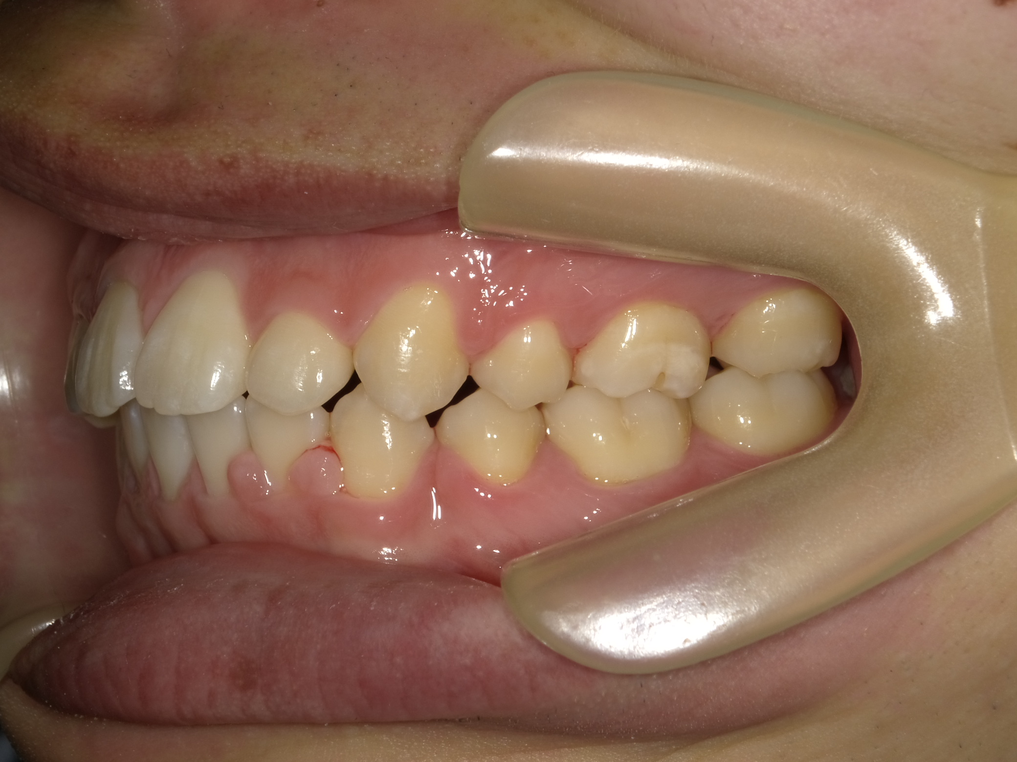 上下顎前突治療後症例画像