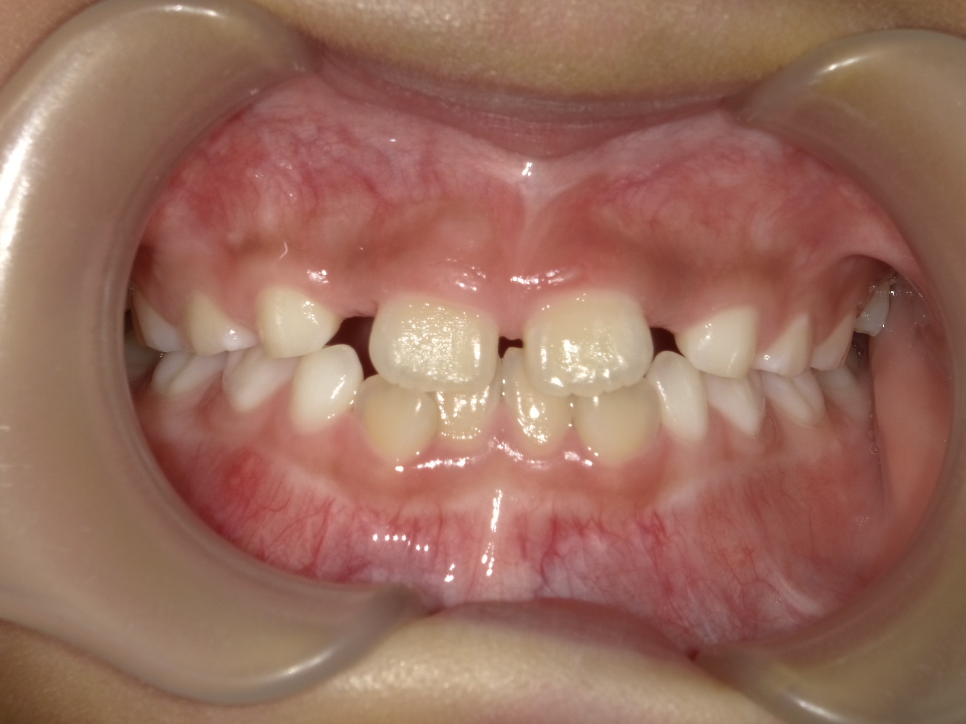 すきっ歯症例画像