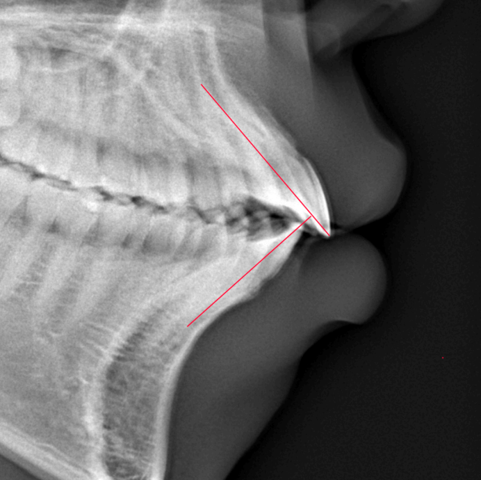 横顔レントゲンBefore