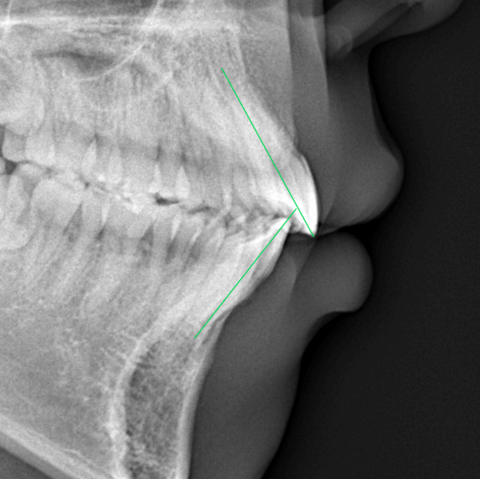 横顔レントゲンafter