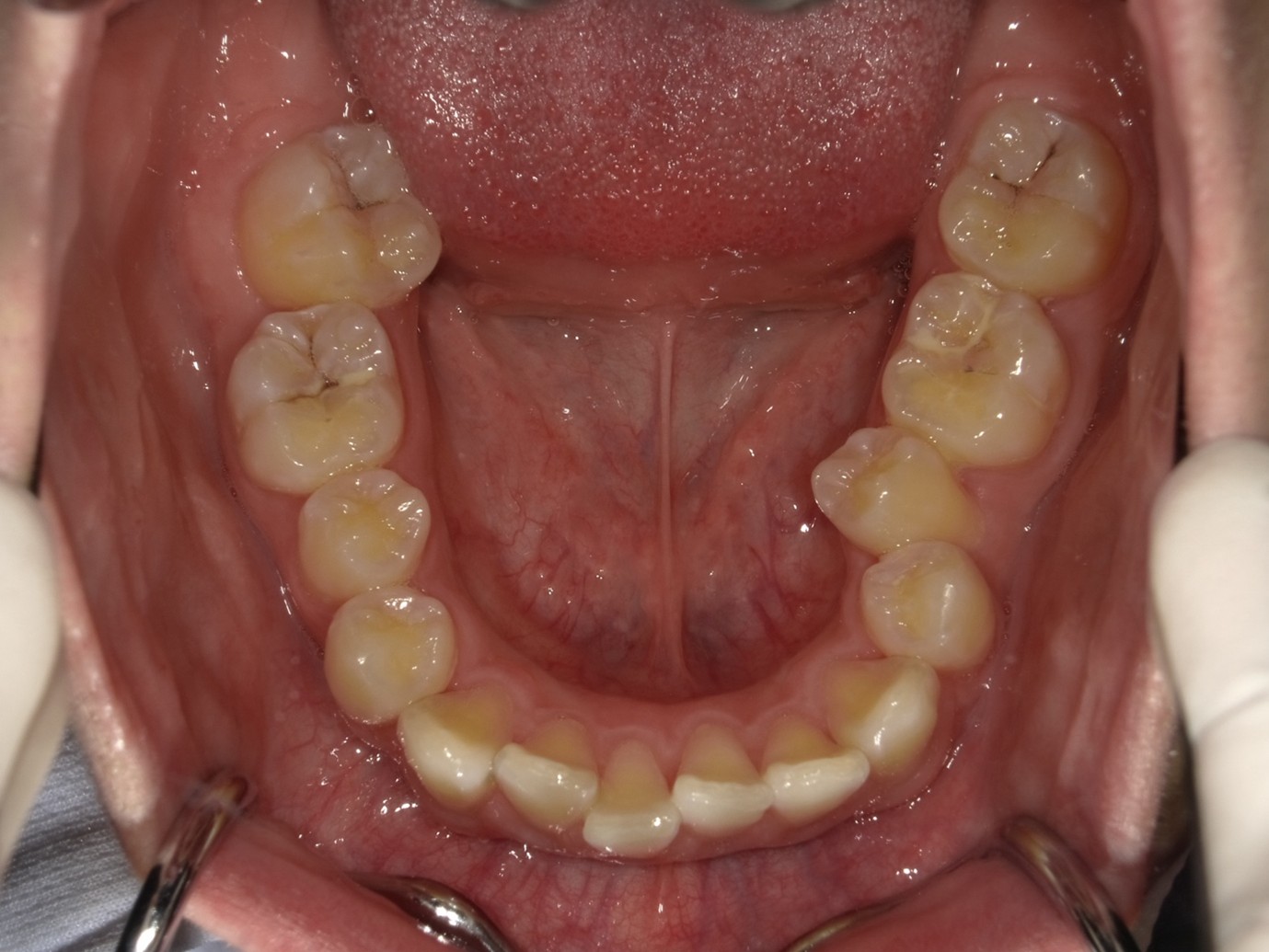 過蓋咬合症例After