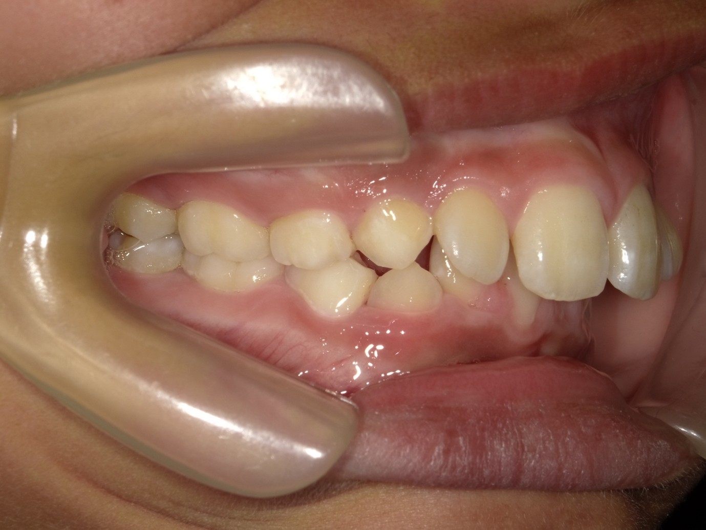 過蓋咬合症例Before