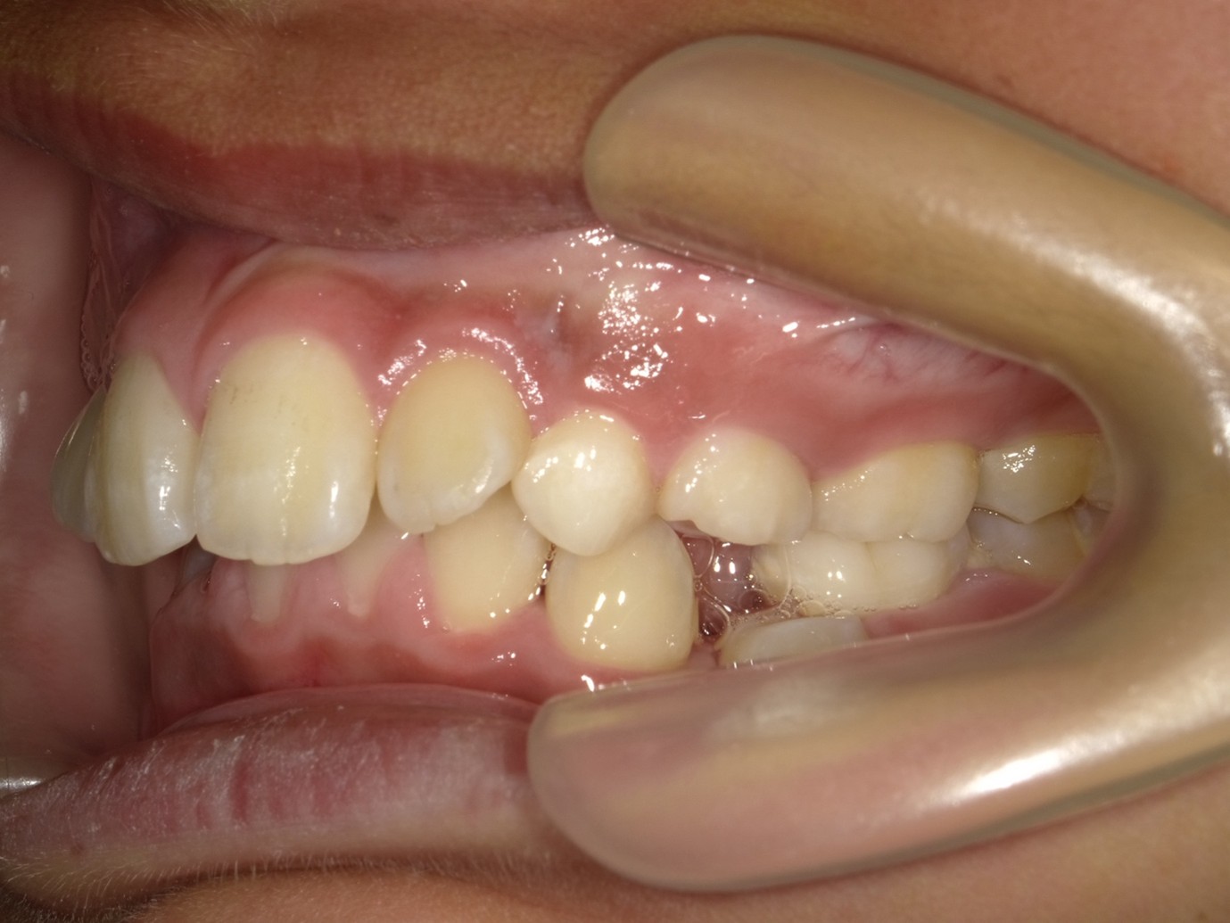 過蓋咬合症例Before