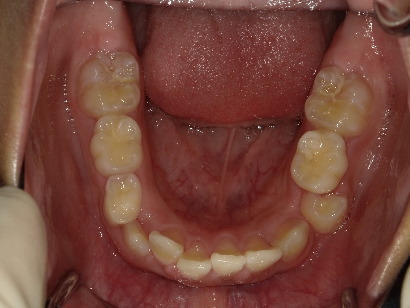 過蓋咬合症例Before