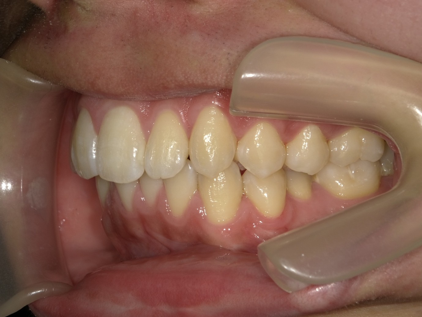 過蓋咬合症例After