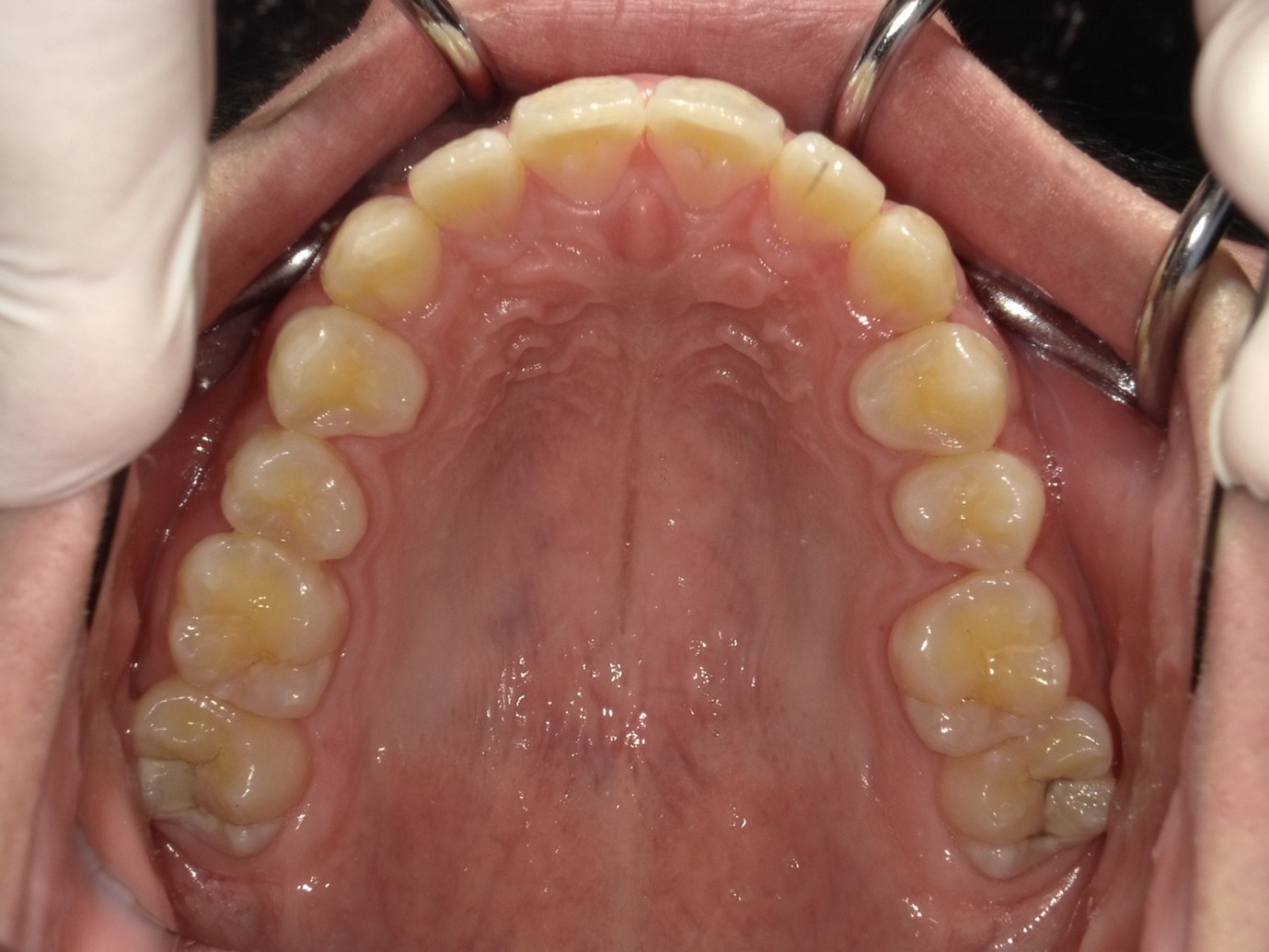 過蓋咬合症例After