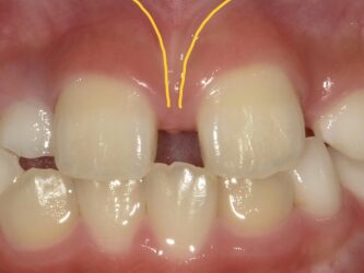 成人矯正症例beforeafter写真