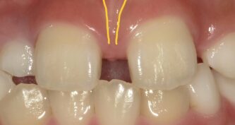 成人矯正の症例beforeafter写真