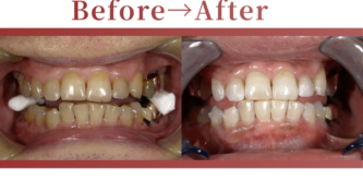 成人矯正の症例beforeafter写真