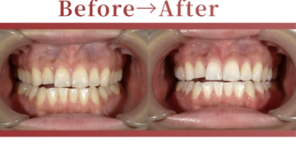 成人矯正の症例beforeafter写真