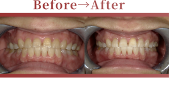 成人矯正の症例beforeafter写真